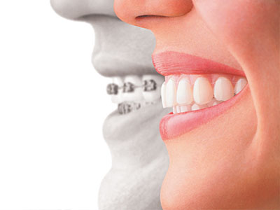 Scheier Dental | Dentures, Root Canals and Sports Mouthguards
