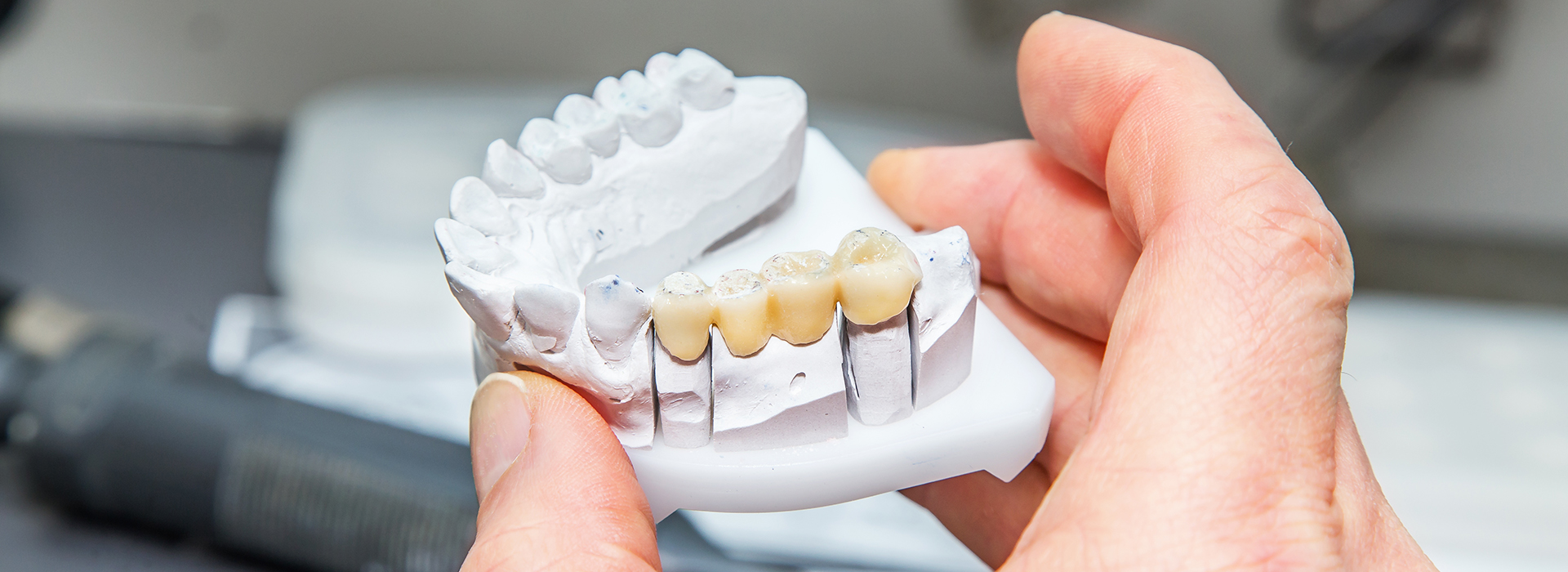 Scheier Dental | CBCT, Sports Mouthguards and Implant Dentistry