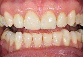 Scheier Dental | Emergency Treatment, Crowns  amp  Caps and Dental Bridges