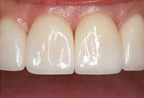 Scheier Dental | Dental Bridges, Night Guards and Dentures