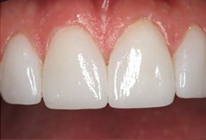 Scheier Dental | Periodontal Treatment, Night Guards and Digital Impressions
