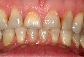 Scheier Dental | Crowns  amp  Caps, CBCT and Teeth Whitening