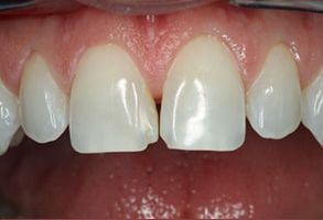 Scheier Dental | Extractions, Crowns  amp  Caps and Dental Fillings